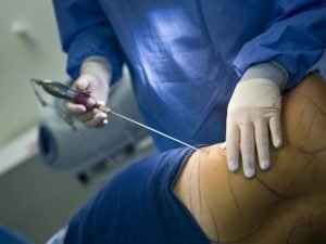 Justiça impede enfermeiros de realizar cirurgias plásticas e vasculares, atos privativos de médicos